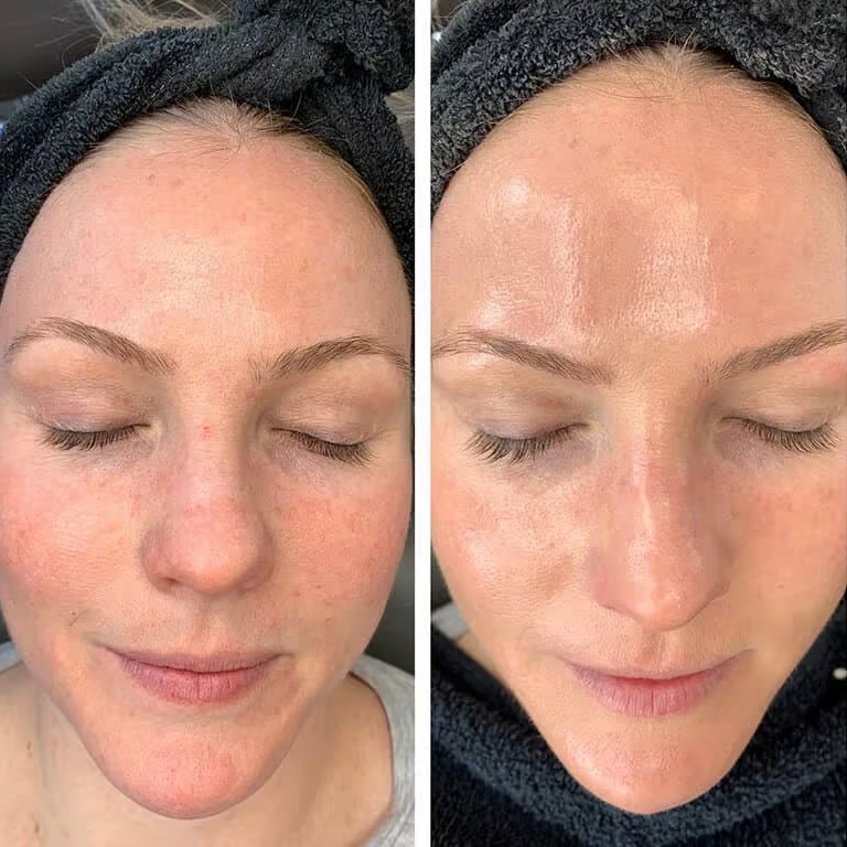 Hydrofacial Treatment