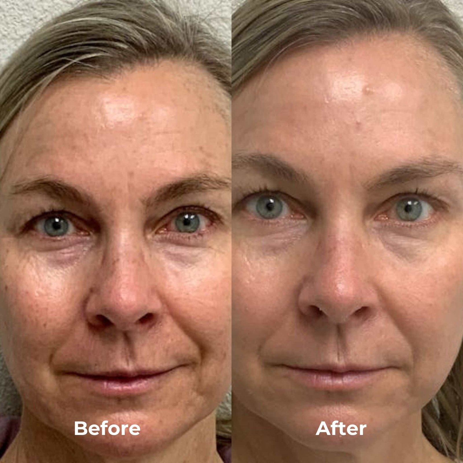 RF Microneedling Treatment