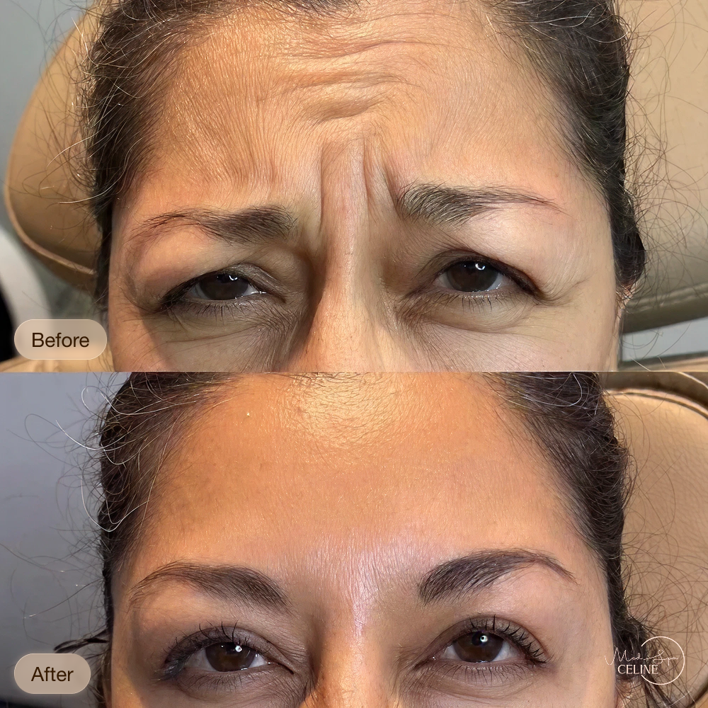Botox before and after