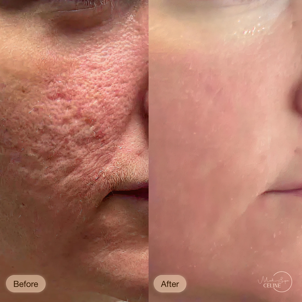 CO2 Laser Facial before and after