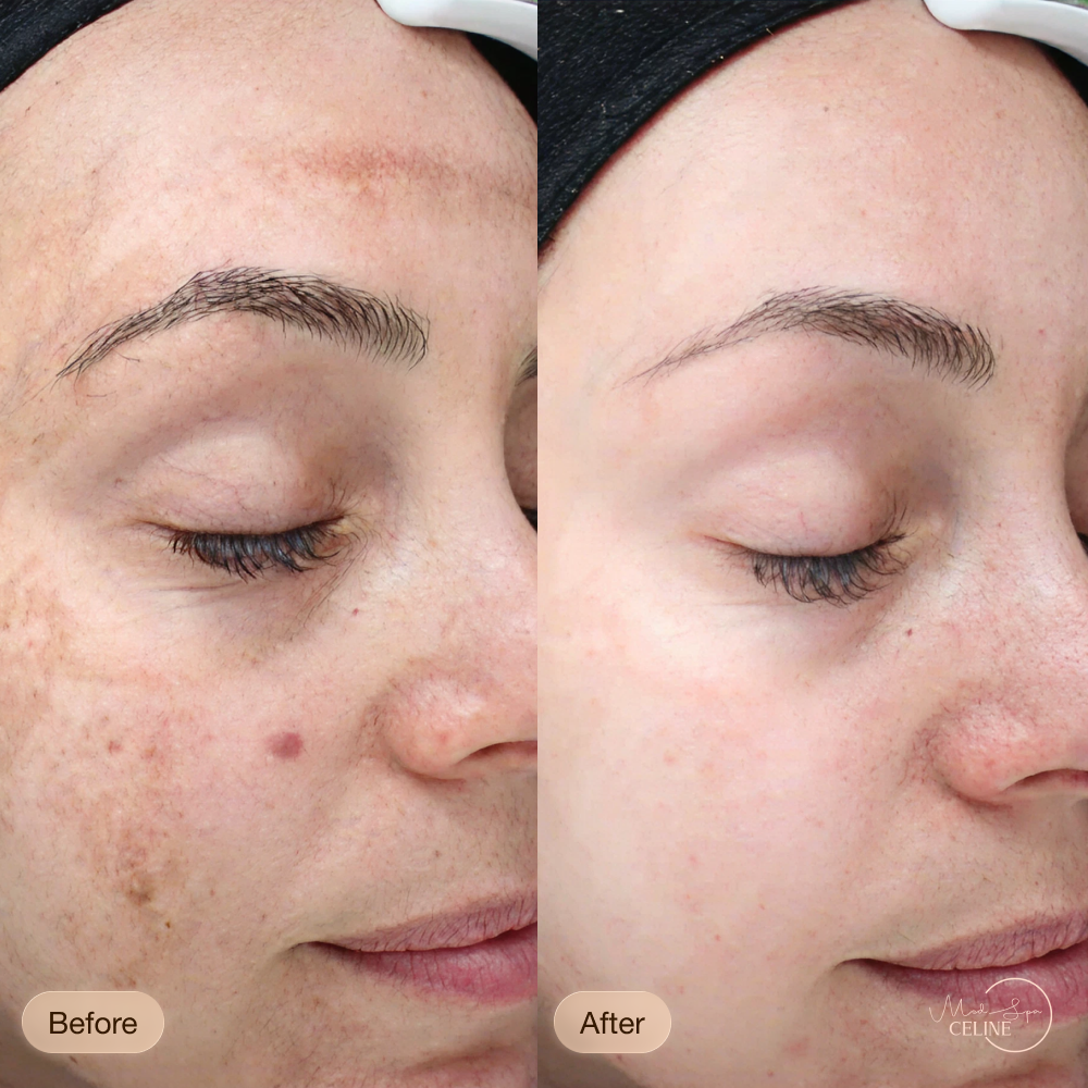 VI Peel before and after